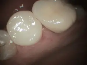 Terril2