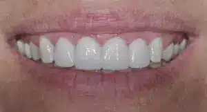 veneers-1-after