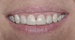veneers-1-before